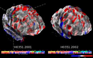 Allen Brain Atlas mappa cervello umano 3D