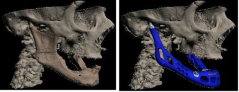 mandibola artificiale stampante 3d