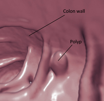 virtual colon polyp 350