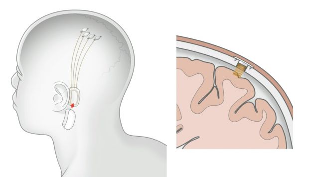 neuralink interfaccia