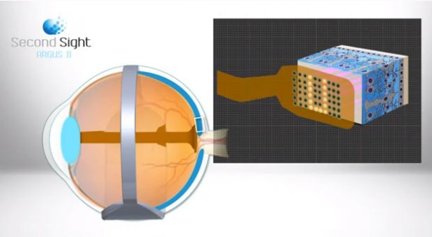 argus implant retina