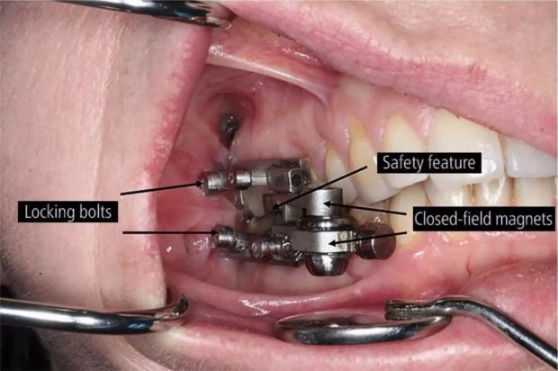 dentalslim02