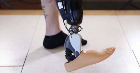 ossur sensor controlled bionic foot